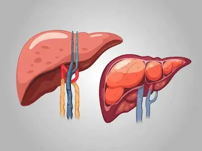 脂肪肝に効果的な食べ物と鍼灸の効果_相模原市訪問診療・在宅支援クリニック彩ブログ